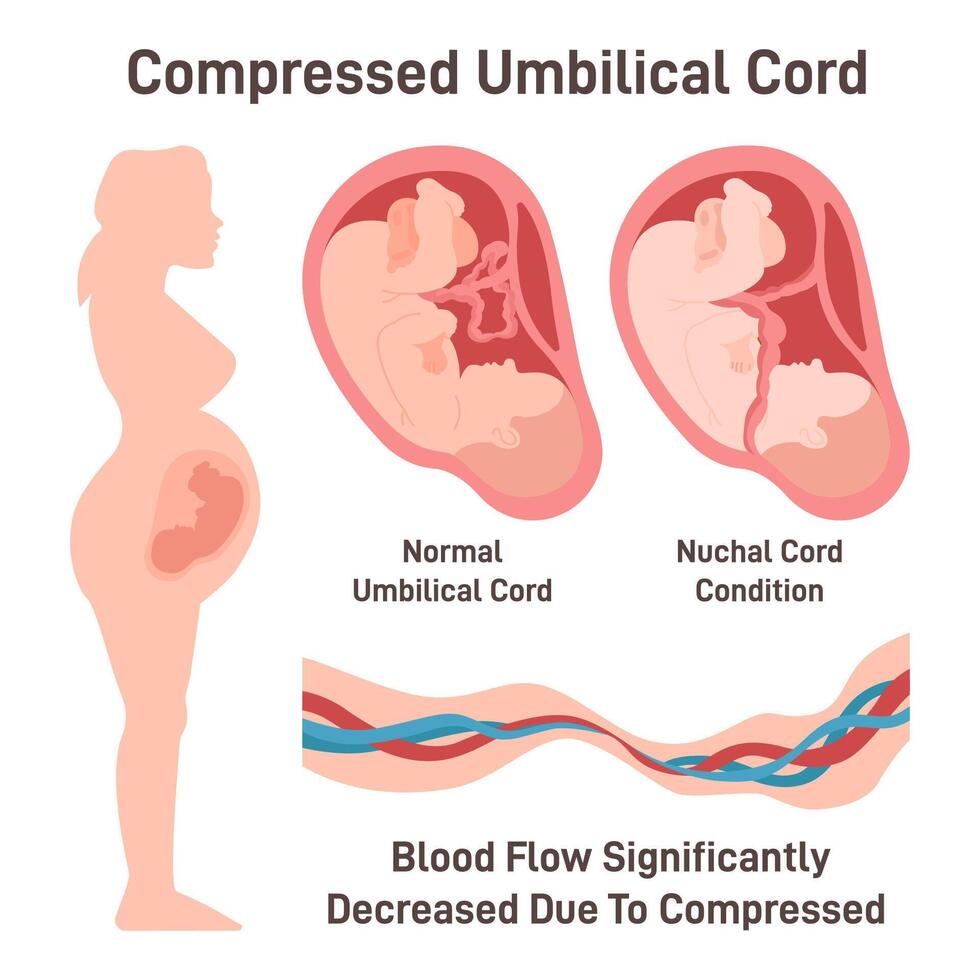 Compressed umbilical cord. Obstruction of blood flow through vector