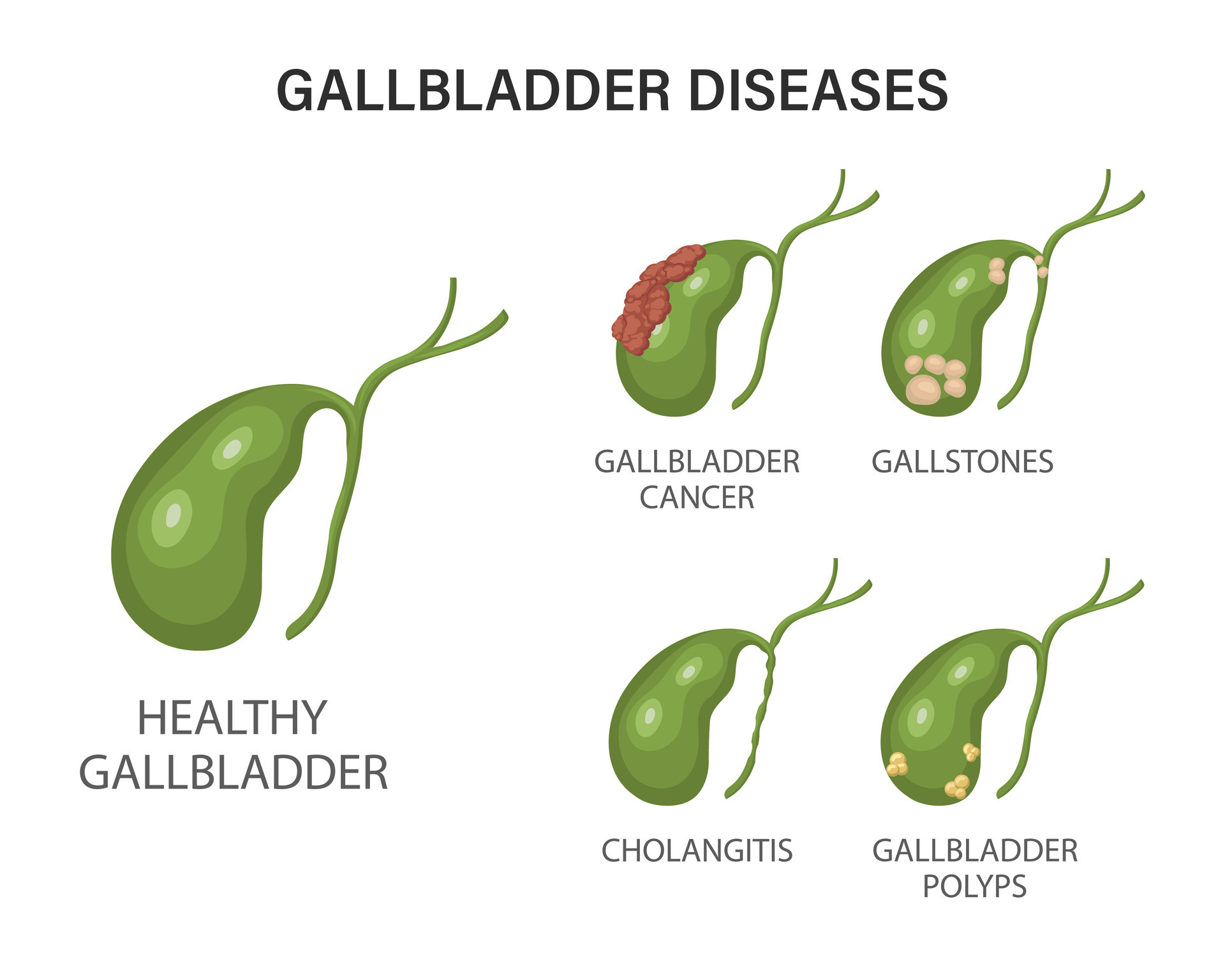 Gallbladder diseases infographics. Gallstone disease, cancer, acute
