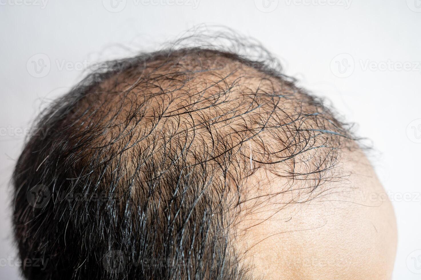 Side view of baldness men's head with thin hair on his top and forehead. Conceptual of hair problem on men's head. photo
