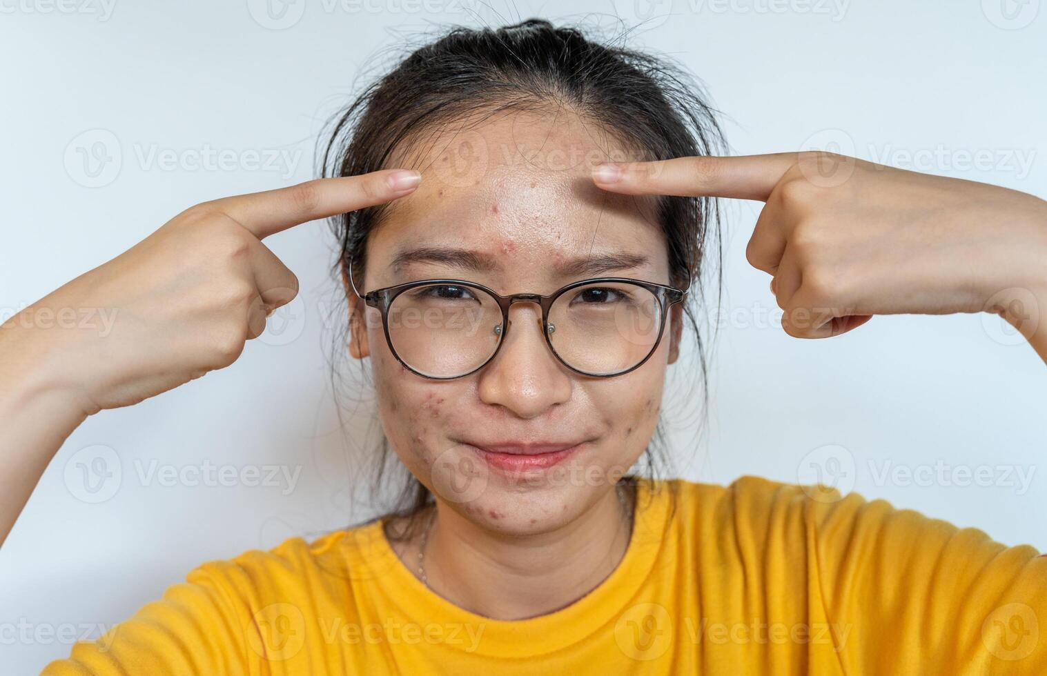 Portrait of unhappy Asian woman pointing to acne inflamed on her forehead. Conceptual shot of Acne and Problem Skin on female face. photo
