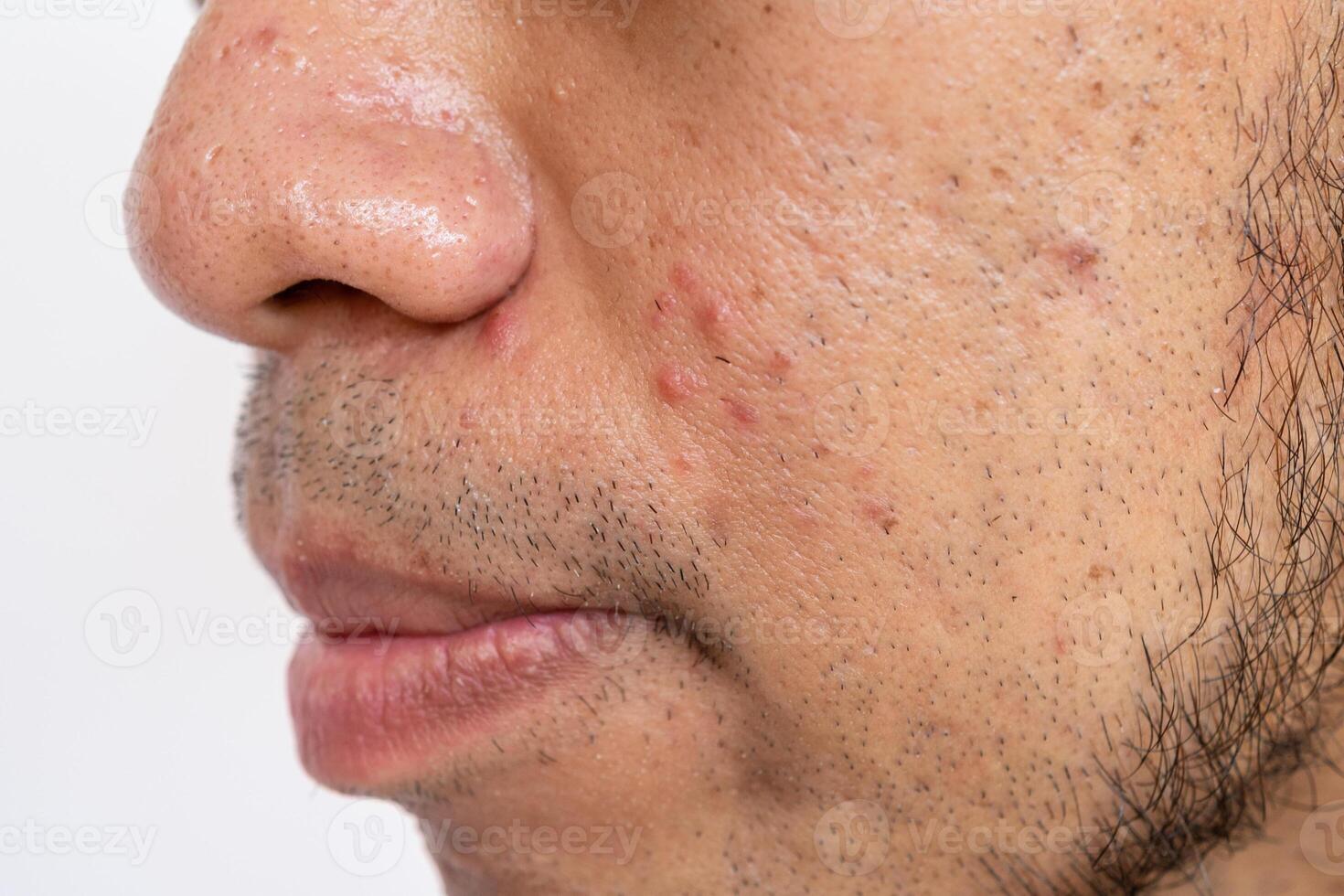 Close up of pores and pimples on men's nose and cheek. Nose pores are openings into the skin, where sebaceous glands produce and distribute the skin's natural oil. photo