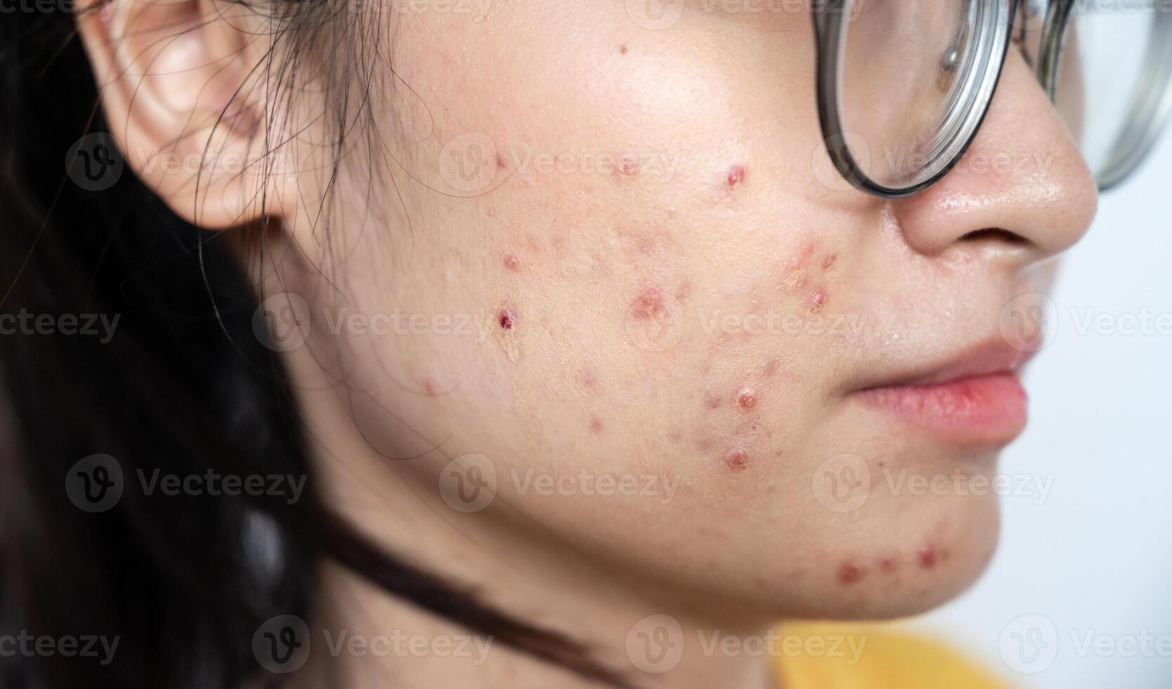 Cropped shot of woman having acne inflammation on her cheek. Inflamed acne consists of swelling, redness, and pores that are deeply clogged with bacteria, oil, and dead skin cells. photo
