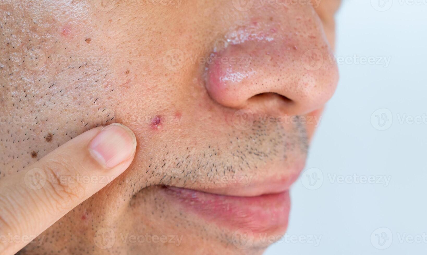 Close up of young man pointing acne occur on his skin. A pimple is a small inflammation or swelling of the skin that may or may not be filled with pus. photo