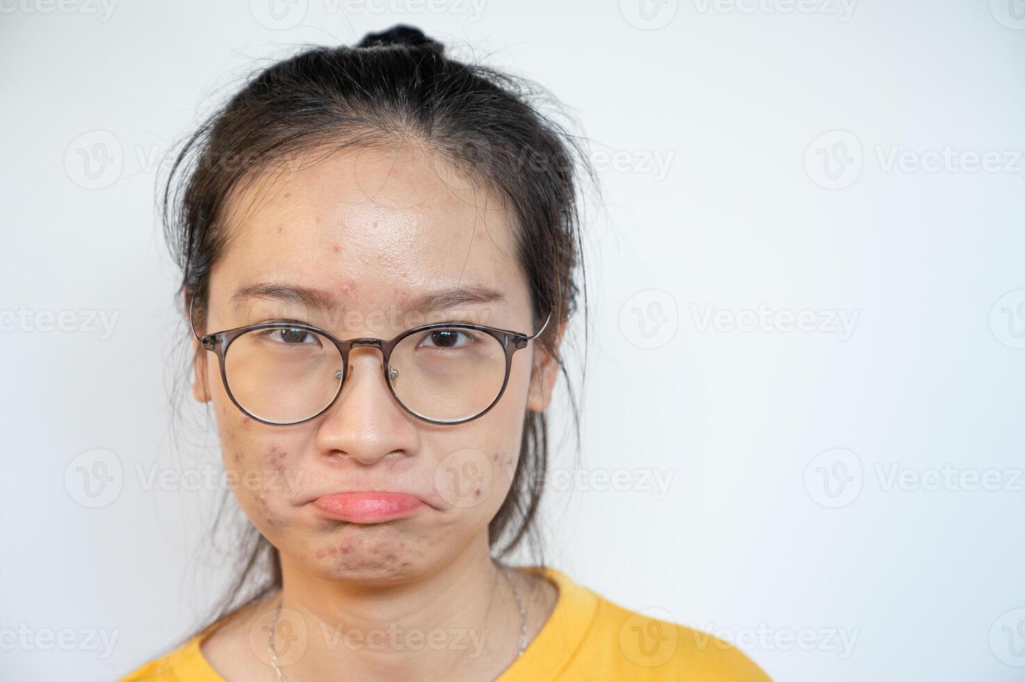 Asian woman having stress cause of acne inflamed on her face. Inflamed acne consists of swelling, redness, and pores that are deeply clogged with bacteria, oil, and dead skin cells. photo
