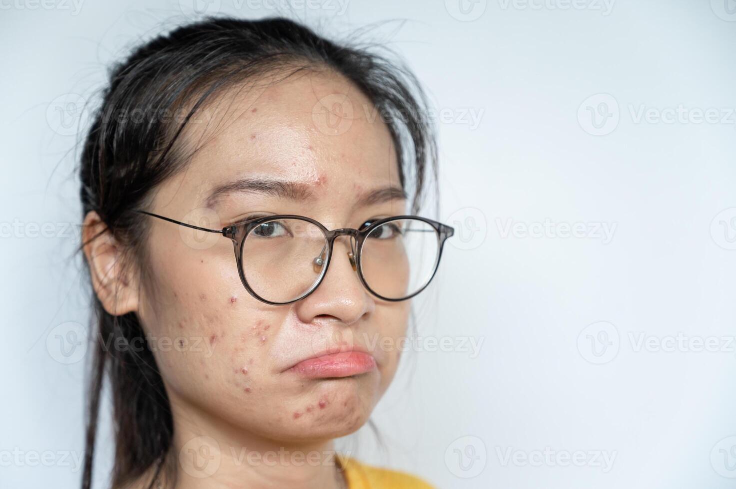 Boring Asian woman having acne inflamed on her face. Inflamed acne consists of swelling, redness, and pores that are deeply clogged with bacteria, oil, and dead skin cells. photo