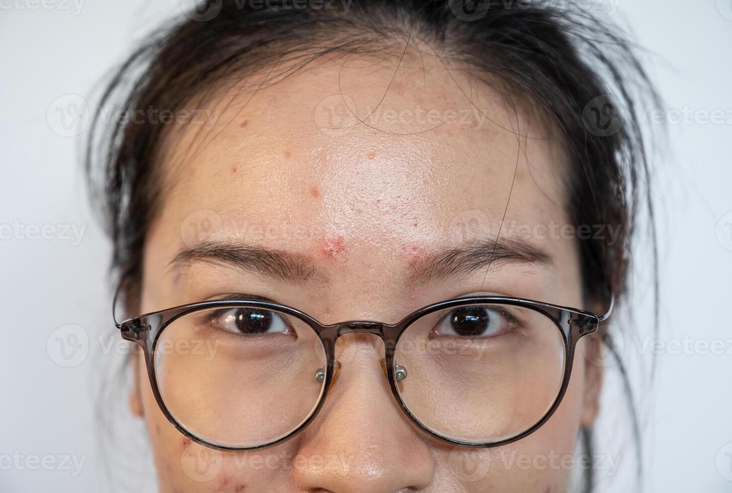 Close up of Asian woman having acne inflamed on her face. Inflamed acne consists of swelling, redness, and pores that are deeply clogged with bacteria, oil, and dead skin cells. photo