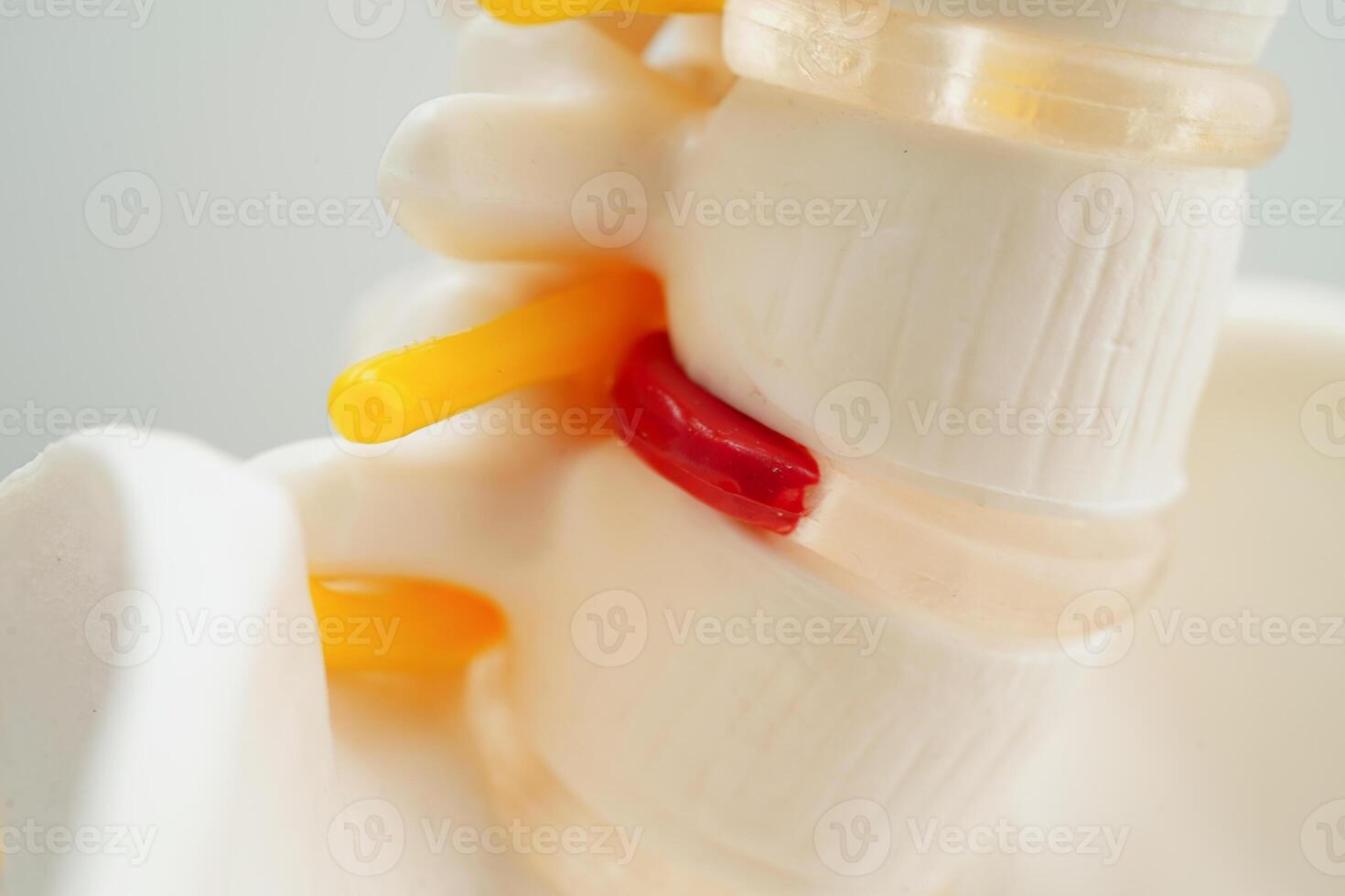 Spinal nerve and bone, Lumbar spine displaced herniated disc fragment, Model for treatment medical in the orthopedic department. photo