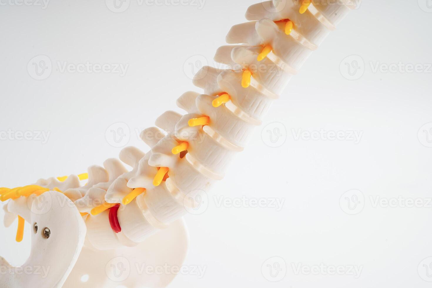 Spinal nerve and bone, Lumbar spine displaced herniated disc fragment, Model for treatment medical in the orthopedic department. photo