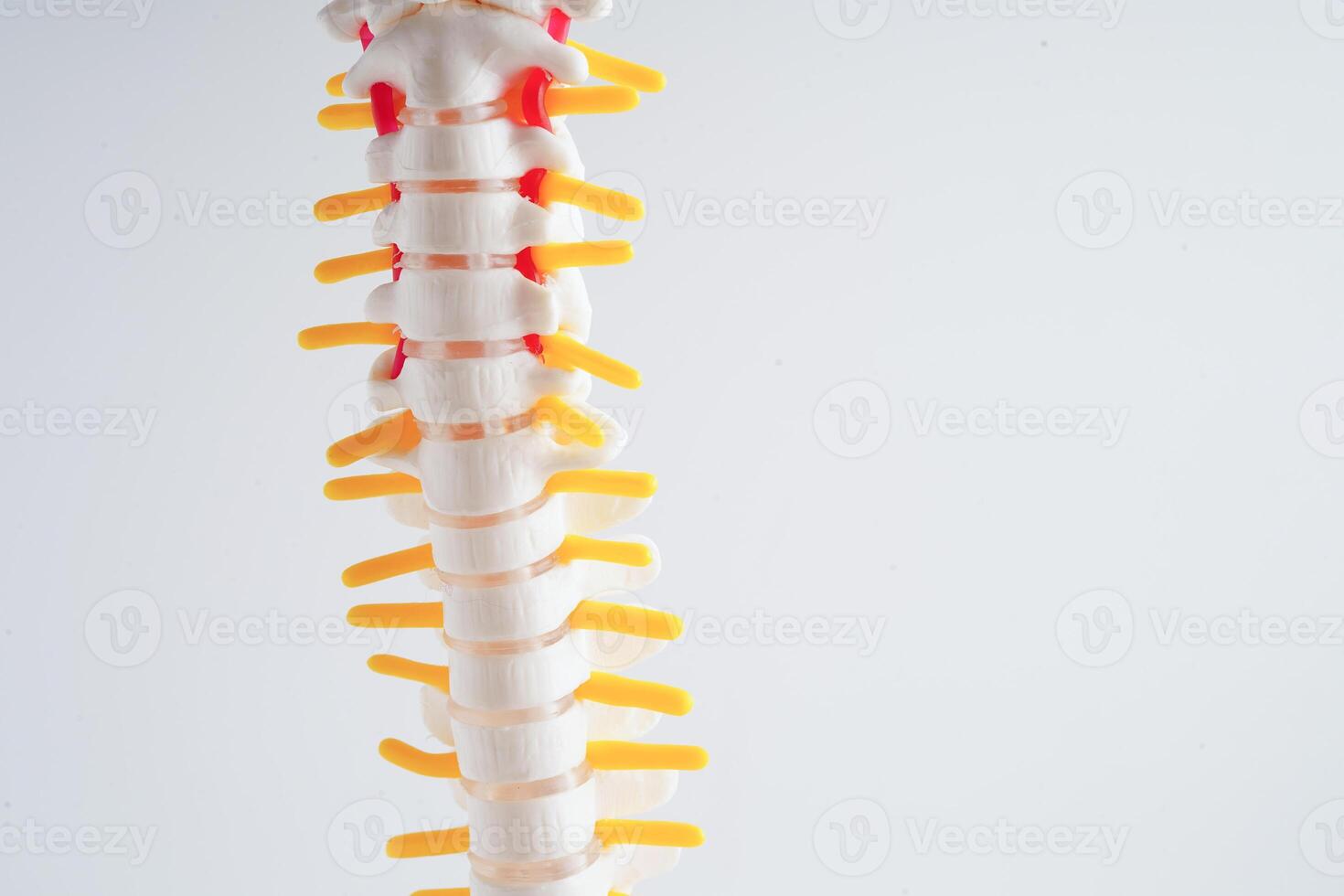Spinal nerve and bone, Lumbar spine displaced herniated disc fragment, Model for treatment medical in the orthopedic department. photo
