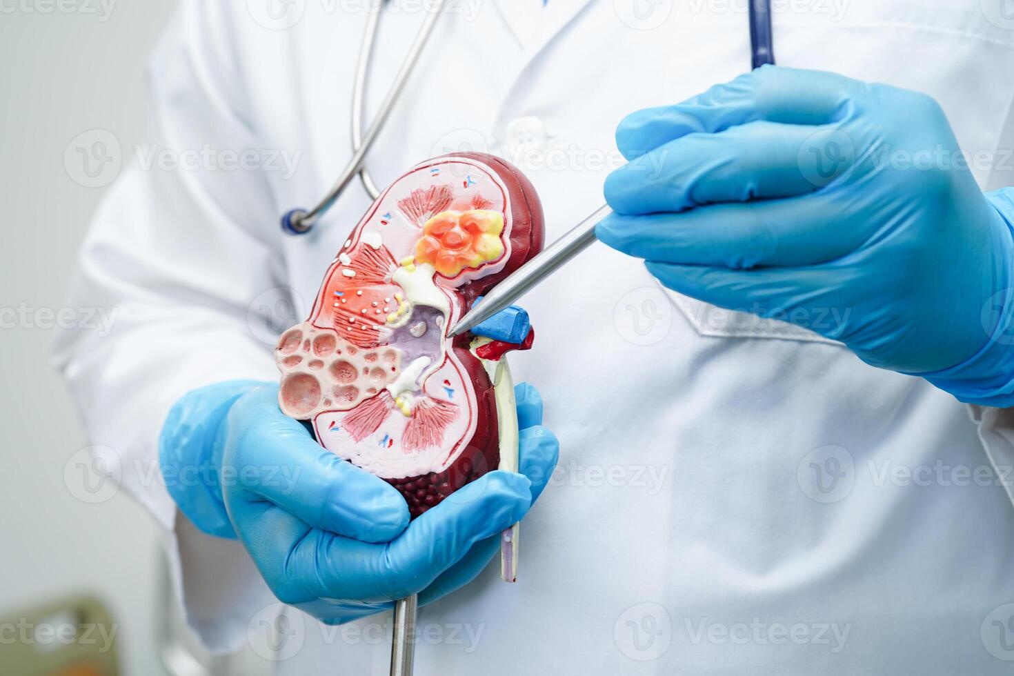 Chronic kidney disease, doctor with model for treatment urinary system, urology, Estimated glomerular filtration rate eGFR. photo