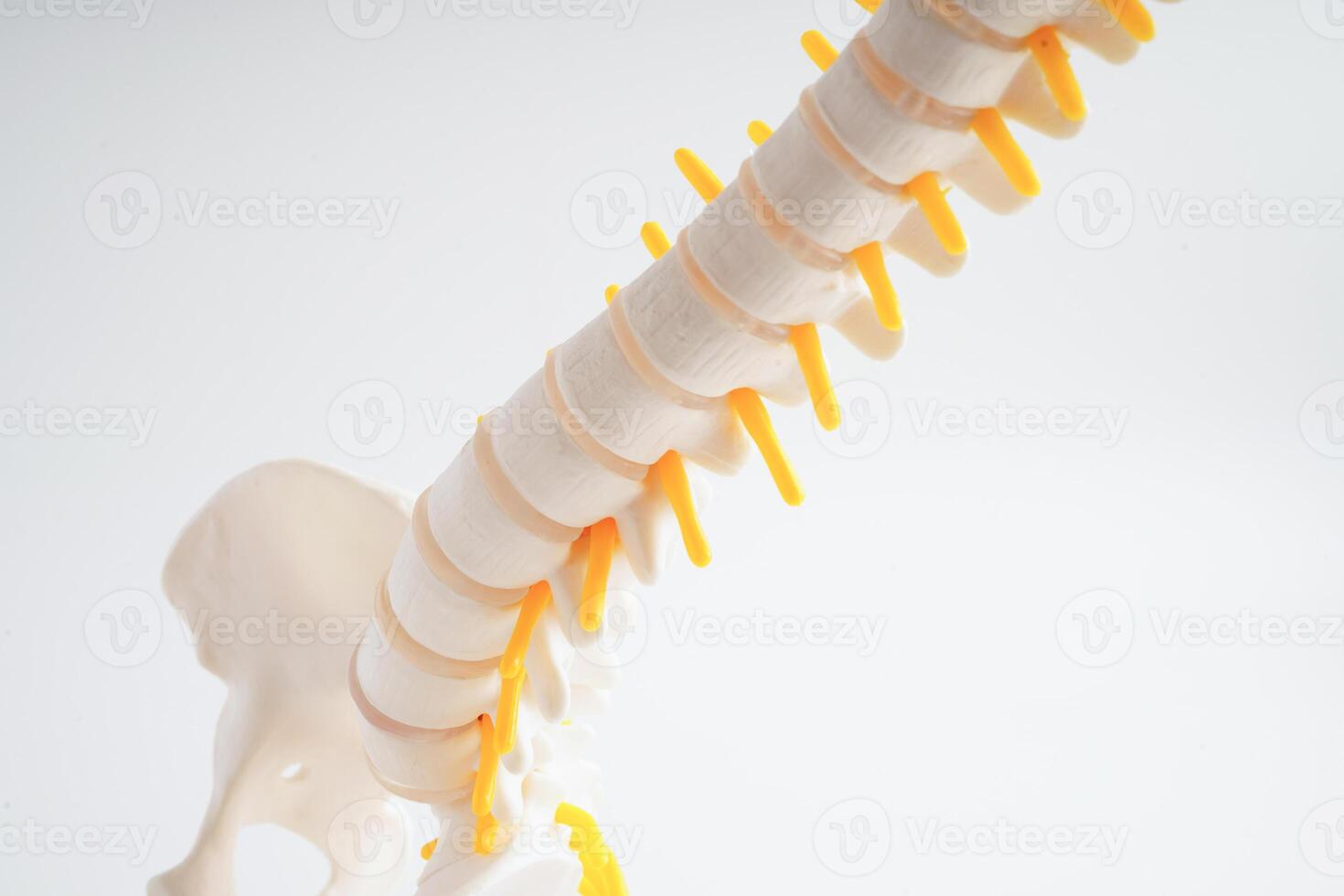 Spinal nerve and bone, Lumbar spine displaced herniated disc fragment, Model for treatment medical in the orthopedic department. photo