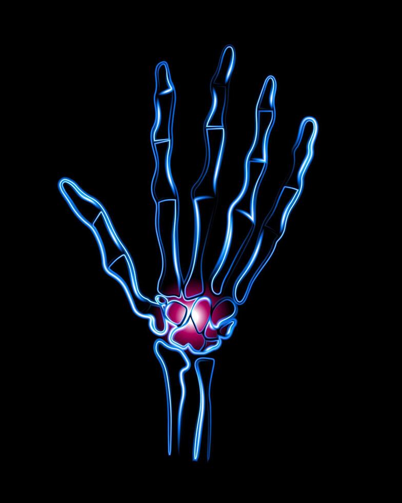 Illustration of wrist pain. Hand with localization of pain in the wrist. vector