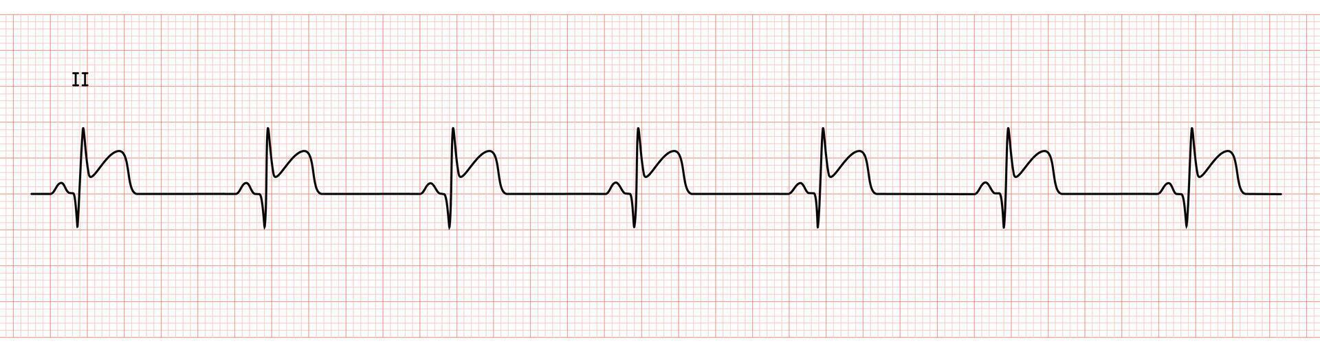 EKG Monitor in lead II Showing Sinus Rhythm with Late STEMI at Inferior Wall with Deep Q Wave vector