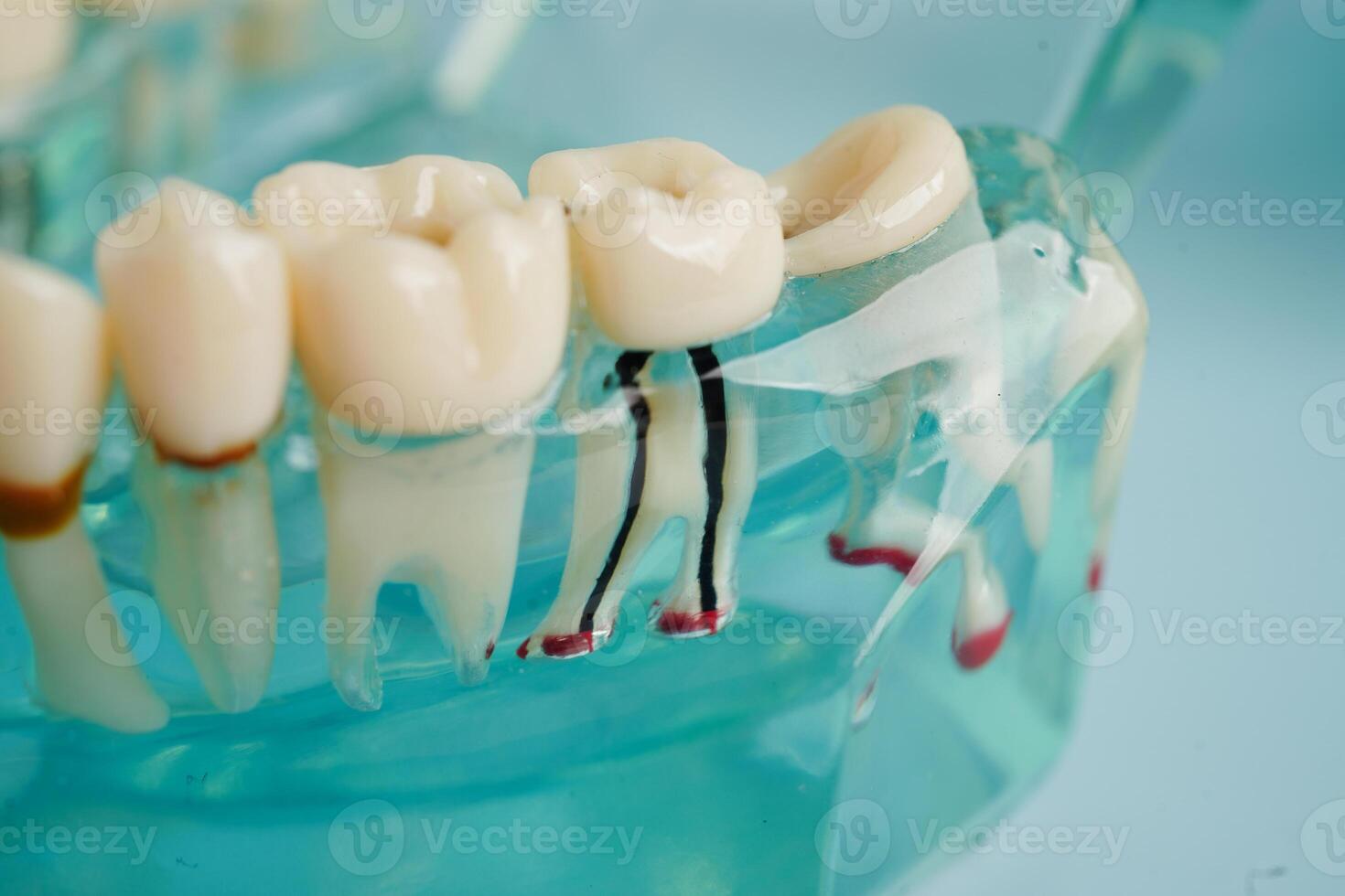 Dental implant, artificial tooth roots into jaw, root canal of dental treatment, gum disease, teeth model for dentist studying about dentistry. photo