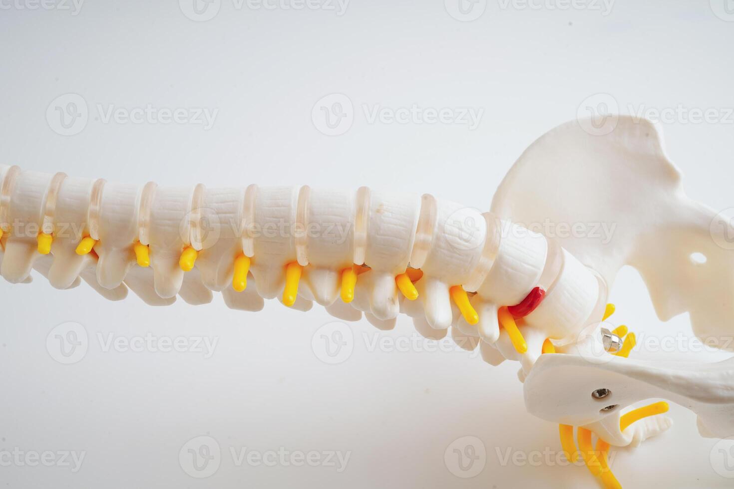 Spinal nerve and bone, Lumbar spine displaced herniated disc fragment, Model for treatment medical in the orthopedic department. photo
