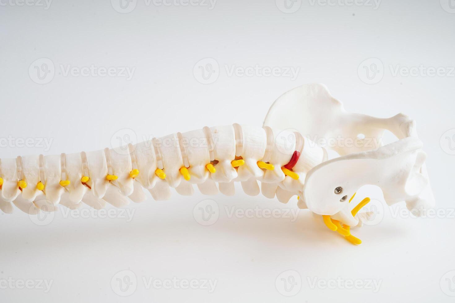 Spinal nerve and bone, Lumbar spine displaced herniated disc fragment, Model for treatment medical in the orthopedic department. photo
