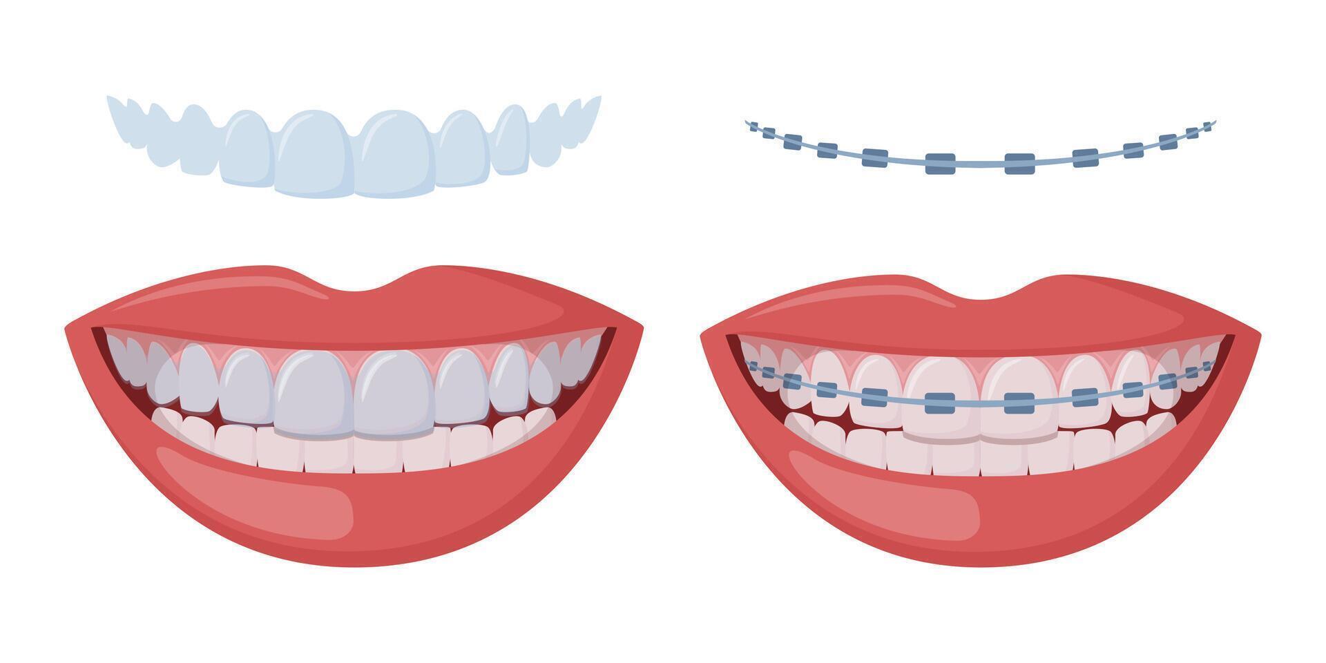 Braces Corrective Orthodontics, smiling female mouth with healthy teeth and braces. Teeth with transparent braces. Alignment of teeth by aligners. Invisible braces aligner, retainer. . vector