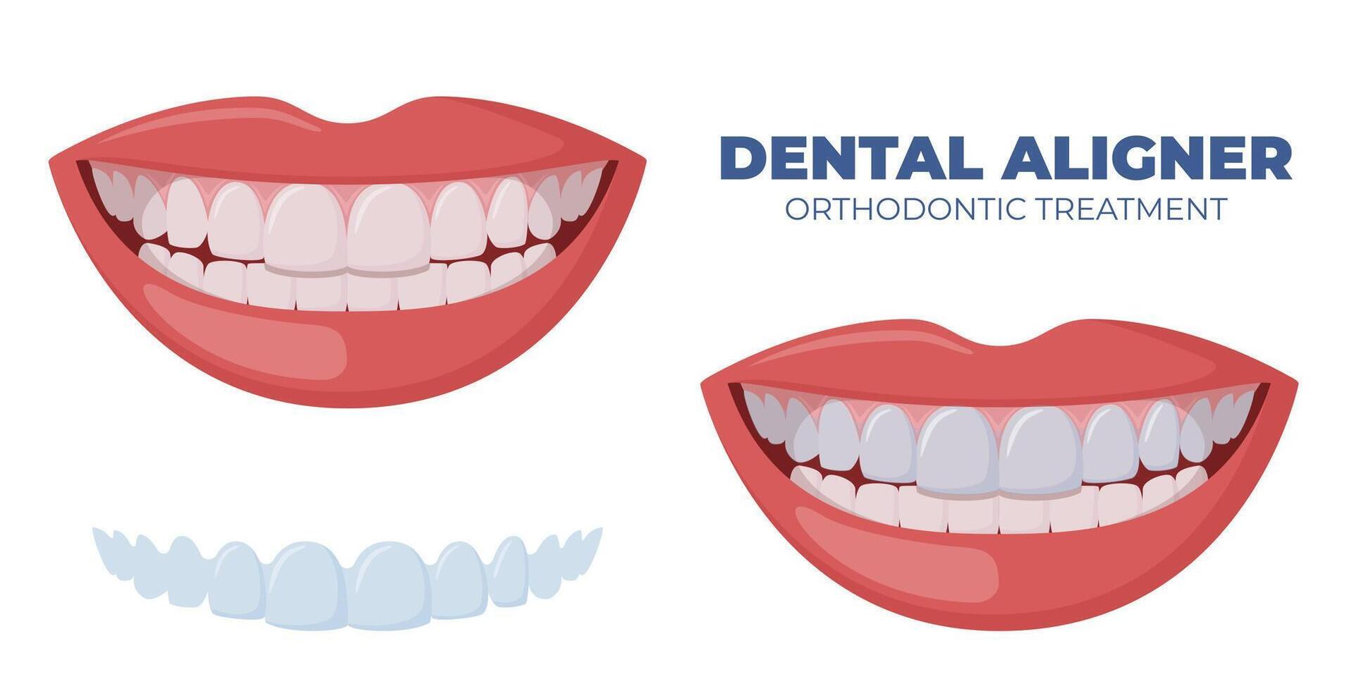 Mouth guard. Teeth with transparent braces. Alignment of teeth by aligners. Orthodontic silicone trainer. Invisible braces aligner, retainer. . vector