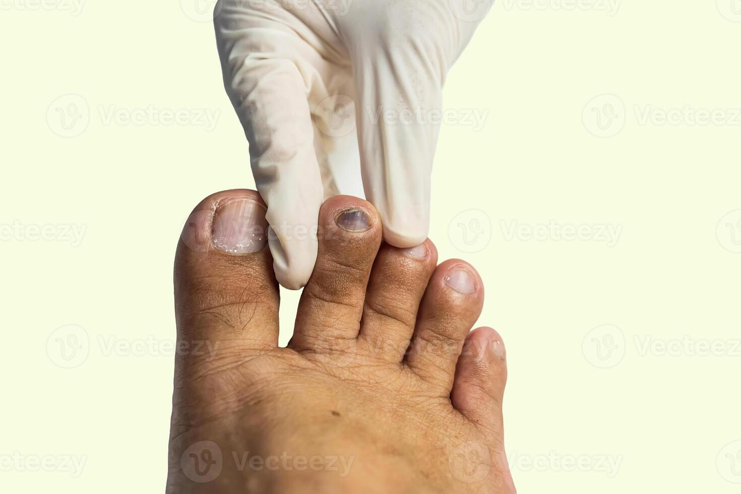 Toenail Subungual Hematoma photo