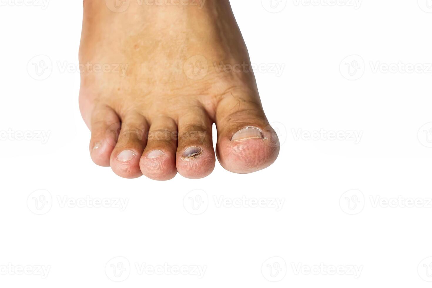 Toenail Subungual Hematoma photo