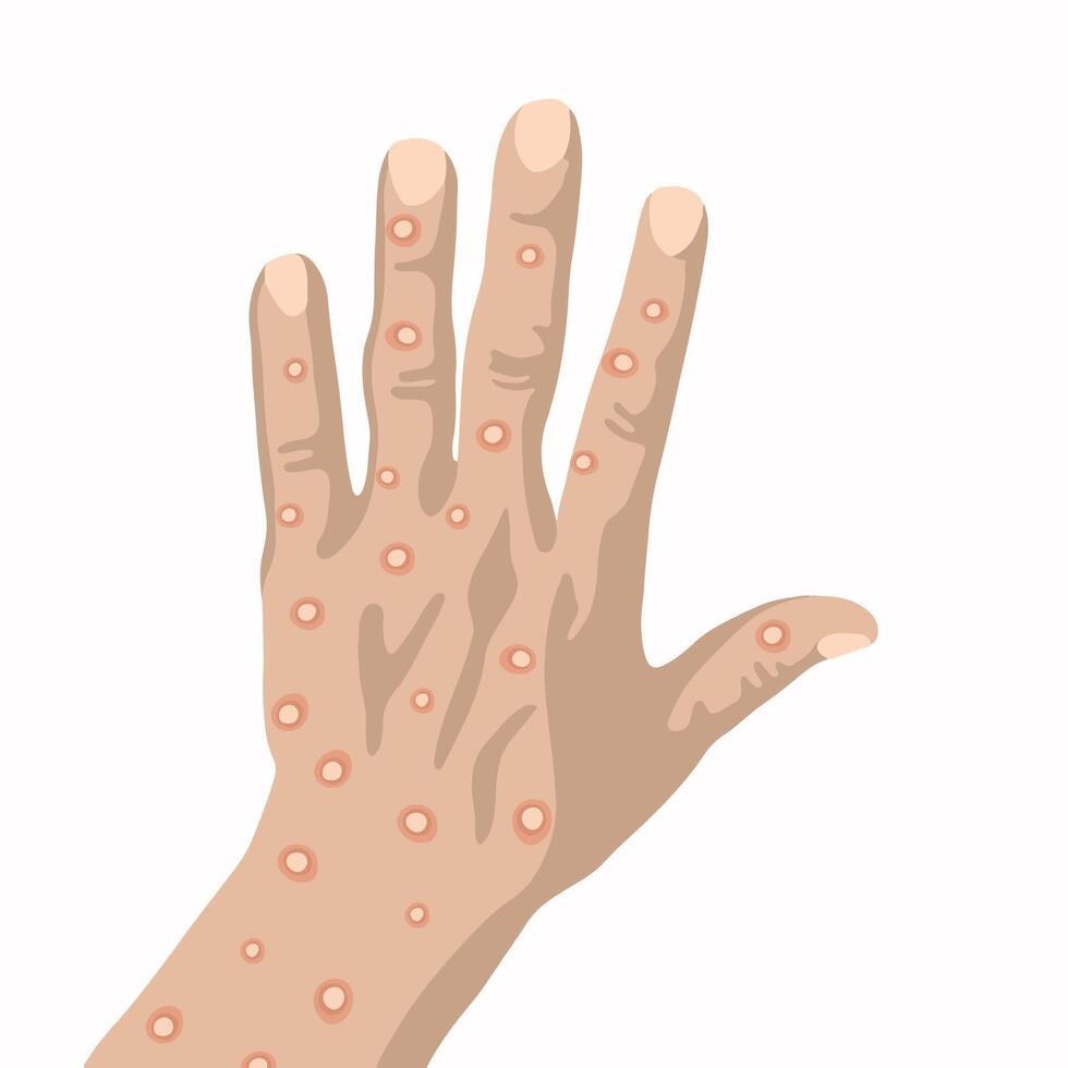 The hand of a person who got smallpox. vector