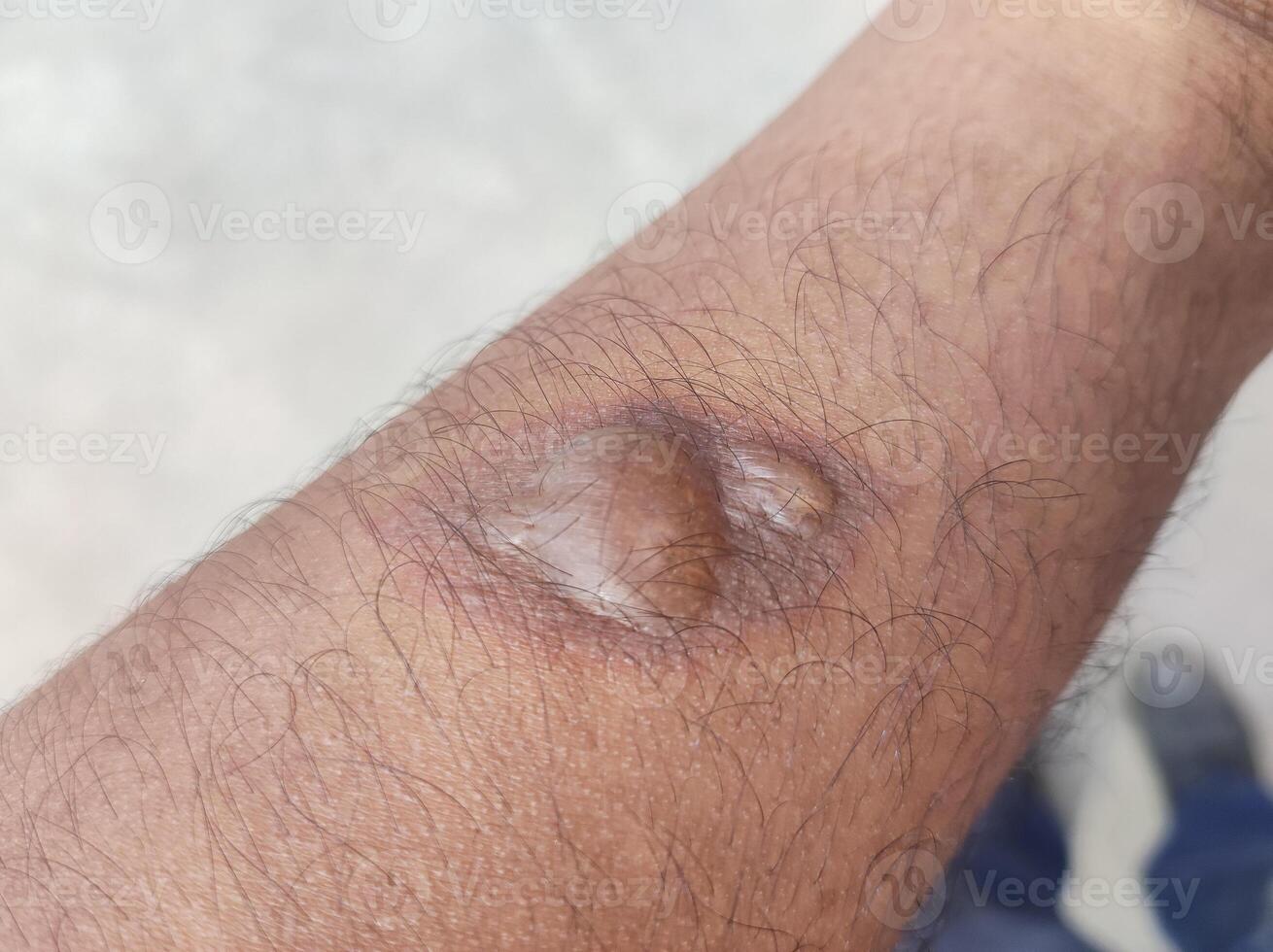 blistered skin due to exposure to hot objects resulting in burns to the skin photo