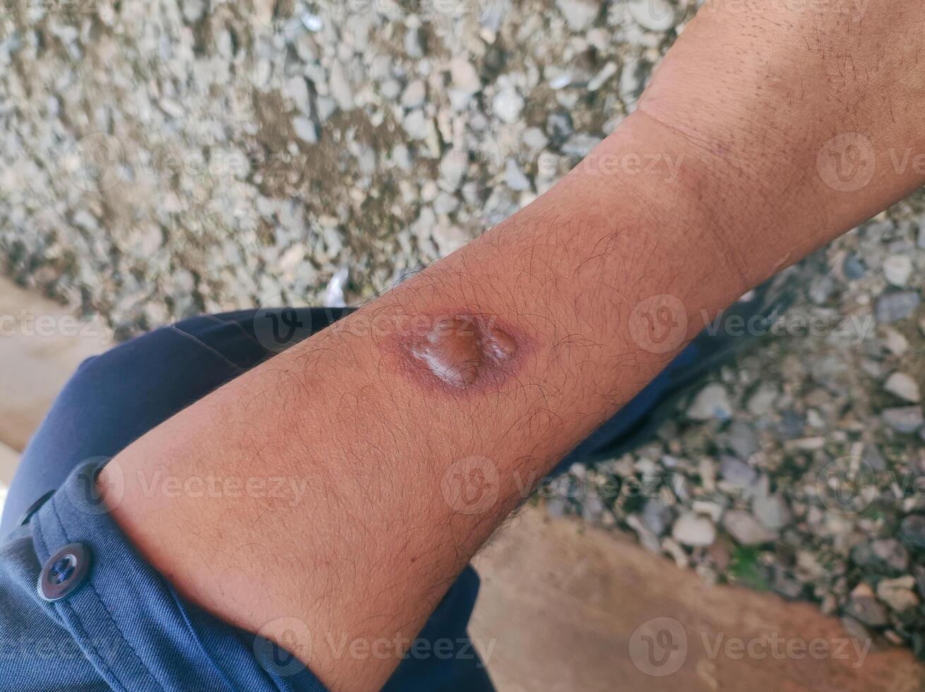 blistered skin due to exposure to hot objects resulting in burns to the skin photo