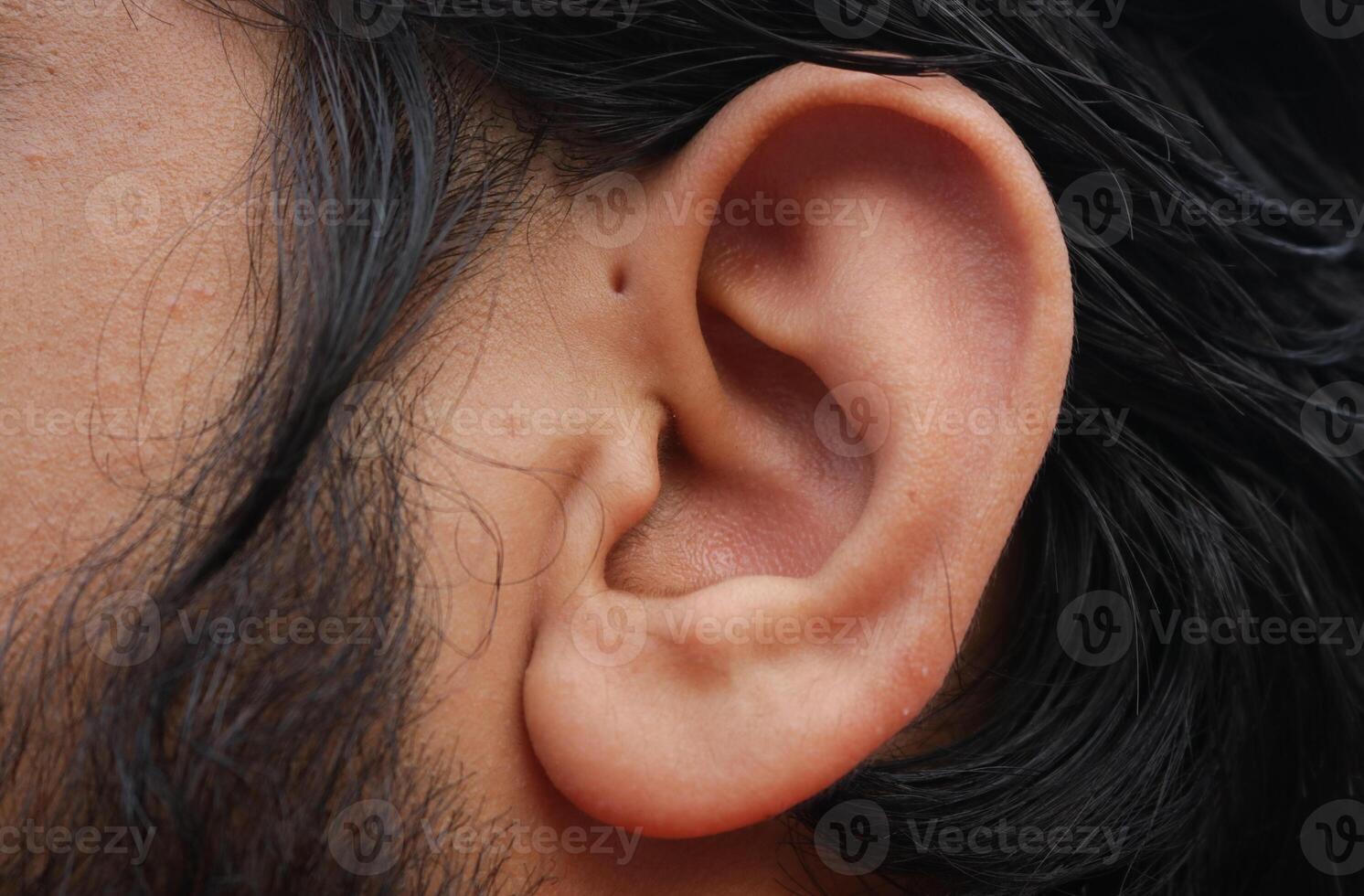 Small hole in front of the upper side of the ear which is known as Preauricular Pit. photo