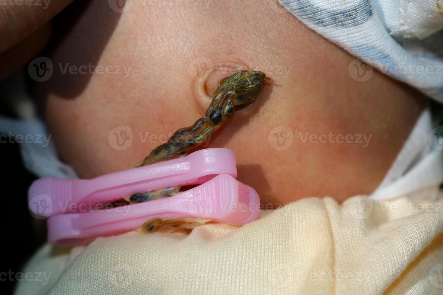 Dried Attached Umbilical cord of newborn. photo