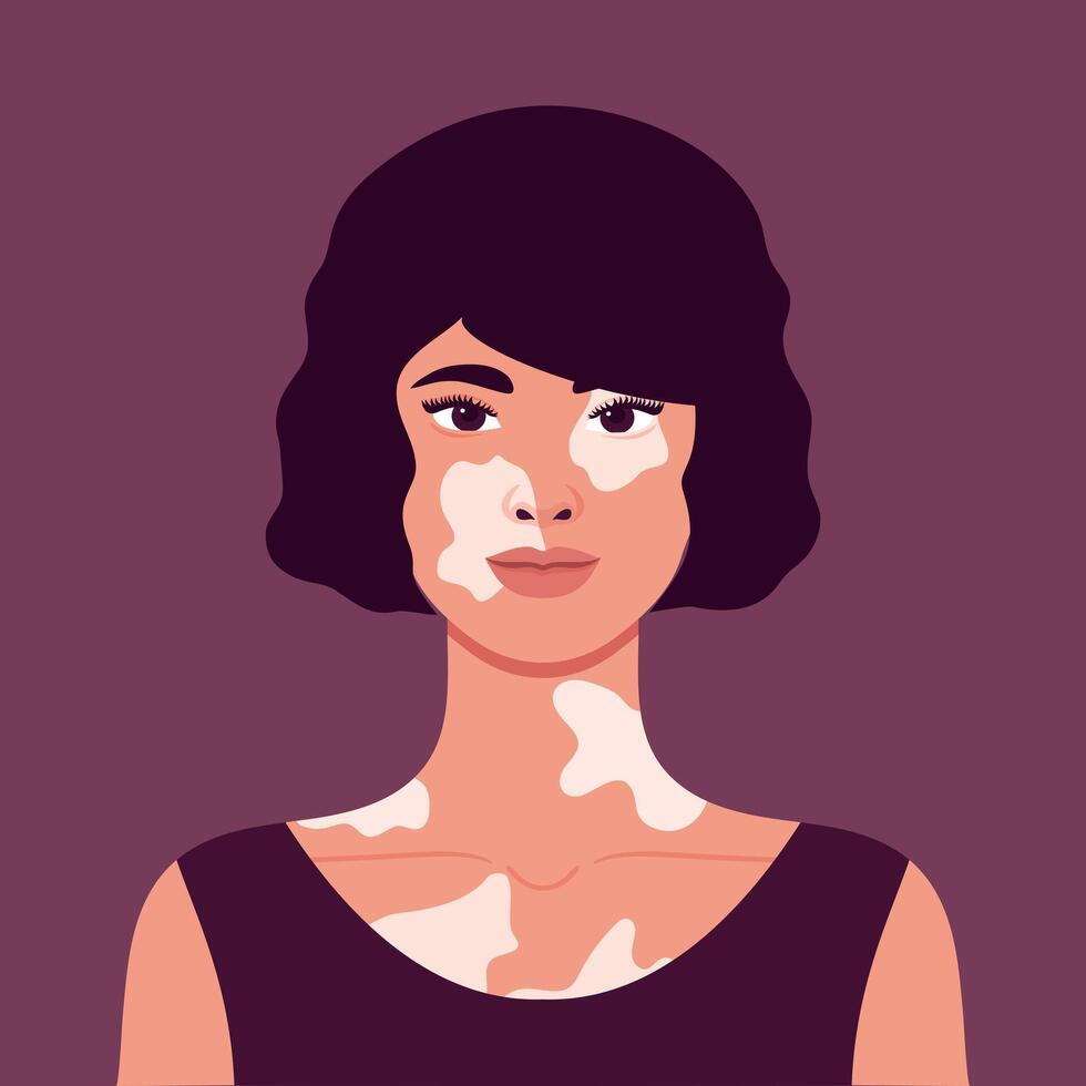 Beautiful young woman with vitiligo depigmentation. Rare appearance. Portrait or an avatar. illustration vector