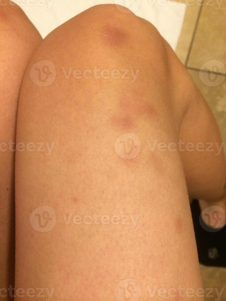 Lots of Little Bruises on My Legs and Thighs photo