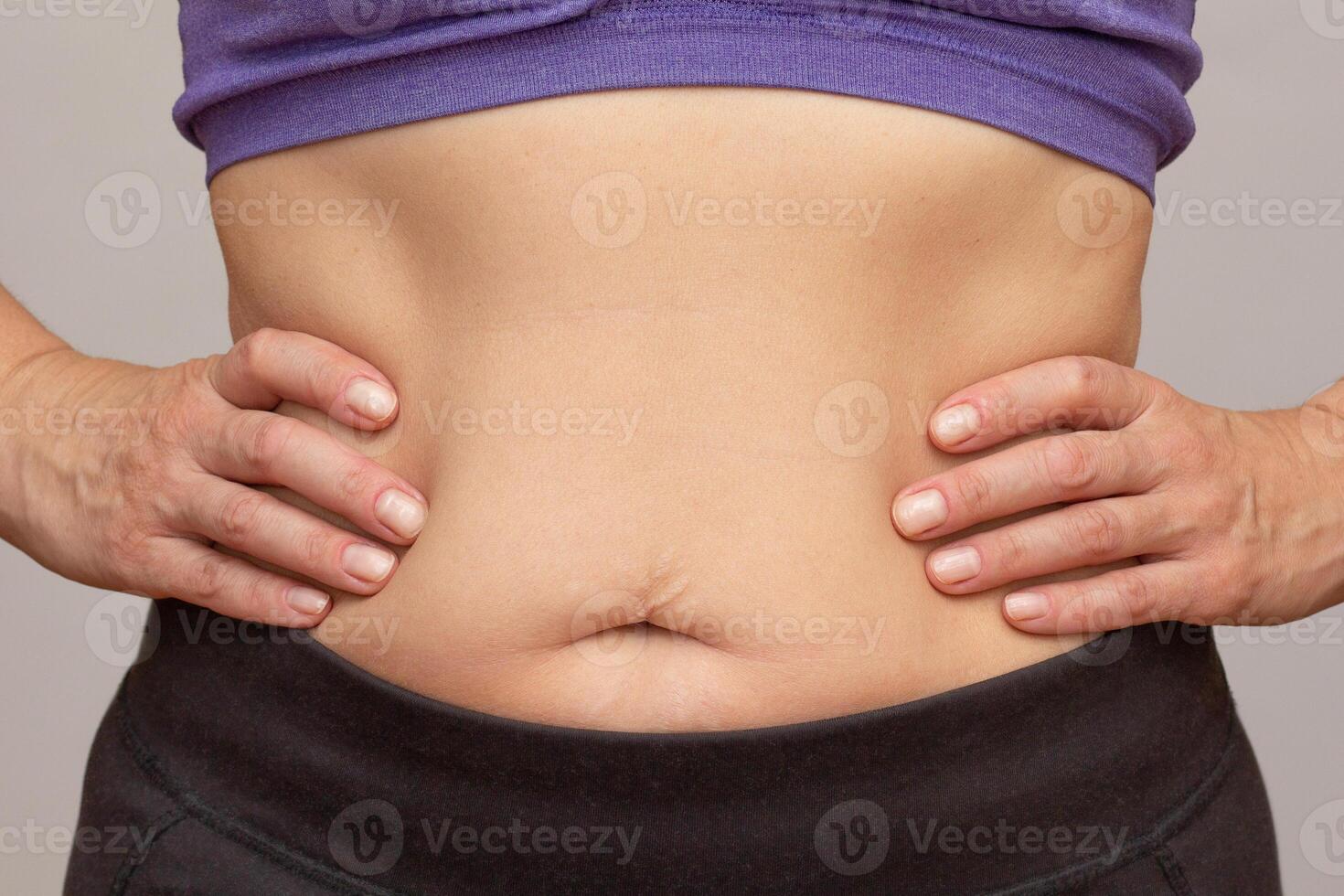 Cropped woman body with hands on waist showing belly sagging skin after diet and stretch marks after pregnancy over gray background photo