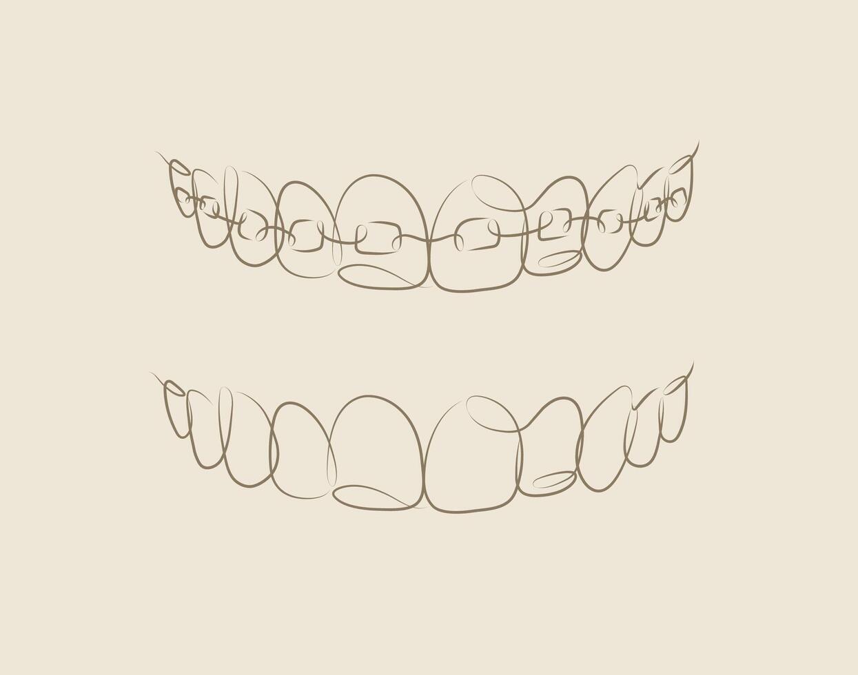 Jaws with and without braces installed drawing in linear style on beige background vector