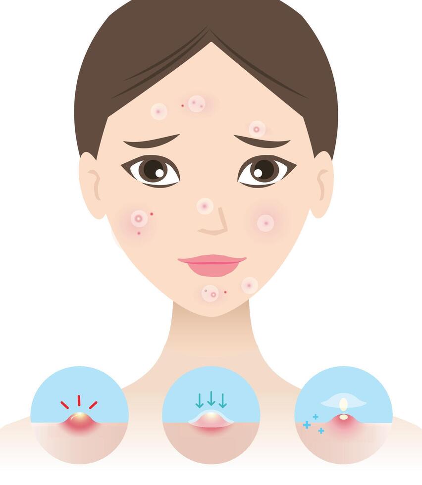 The woman is treating acne by pimple patches for inflammatory acne illustration on white background. Icon set of direction for use acne patch absorbing papule and pustule on skin face. vector