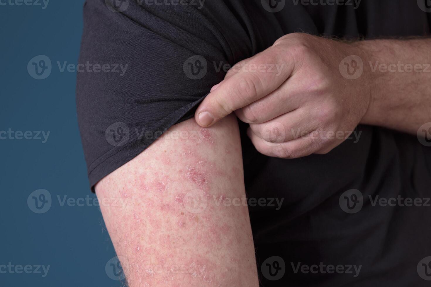 Close up of Erysipelas on the hand. A red rash appears on the forearm photo