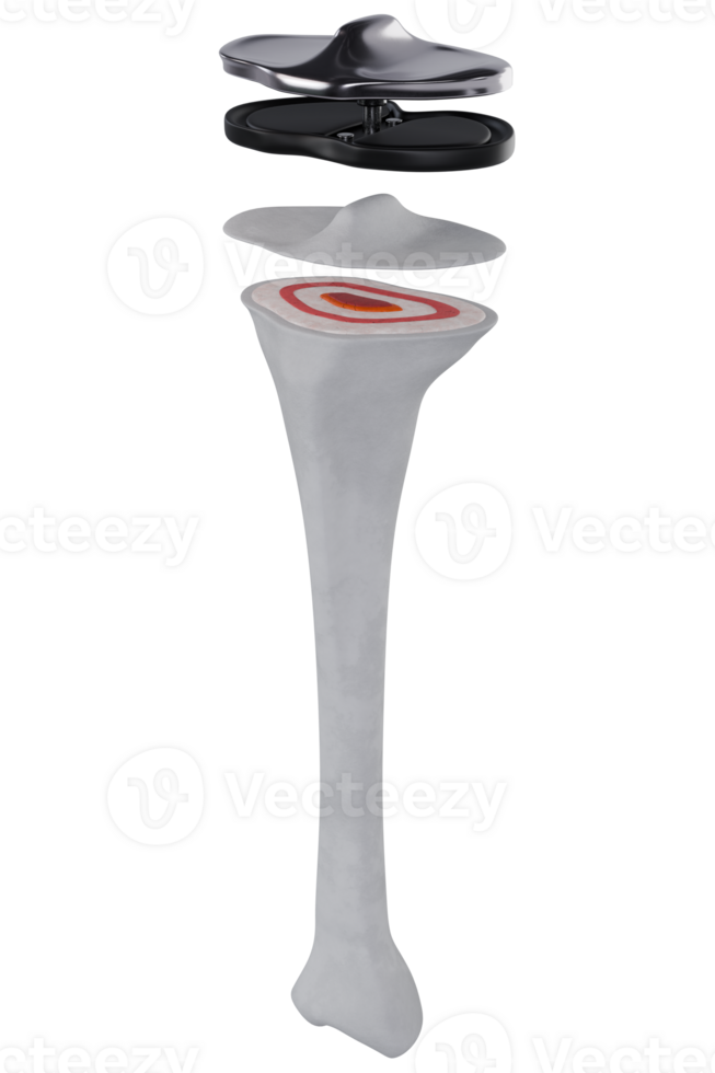 Surgery tibia replace damaged cartilage human bone, knee joint, titanium hinge implant 3d rendering png