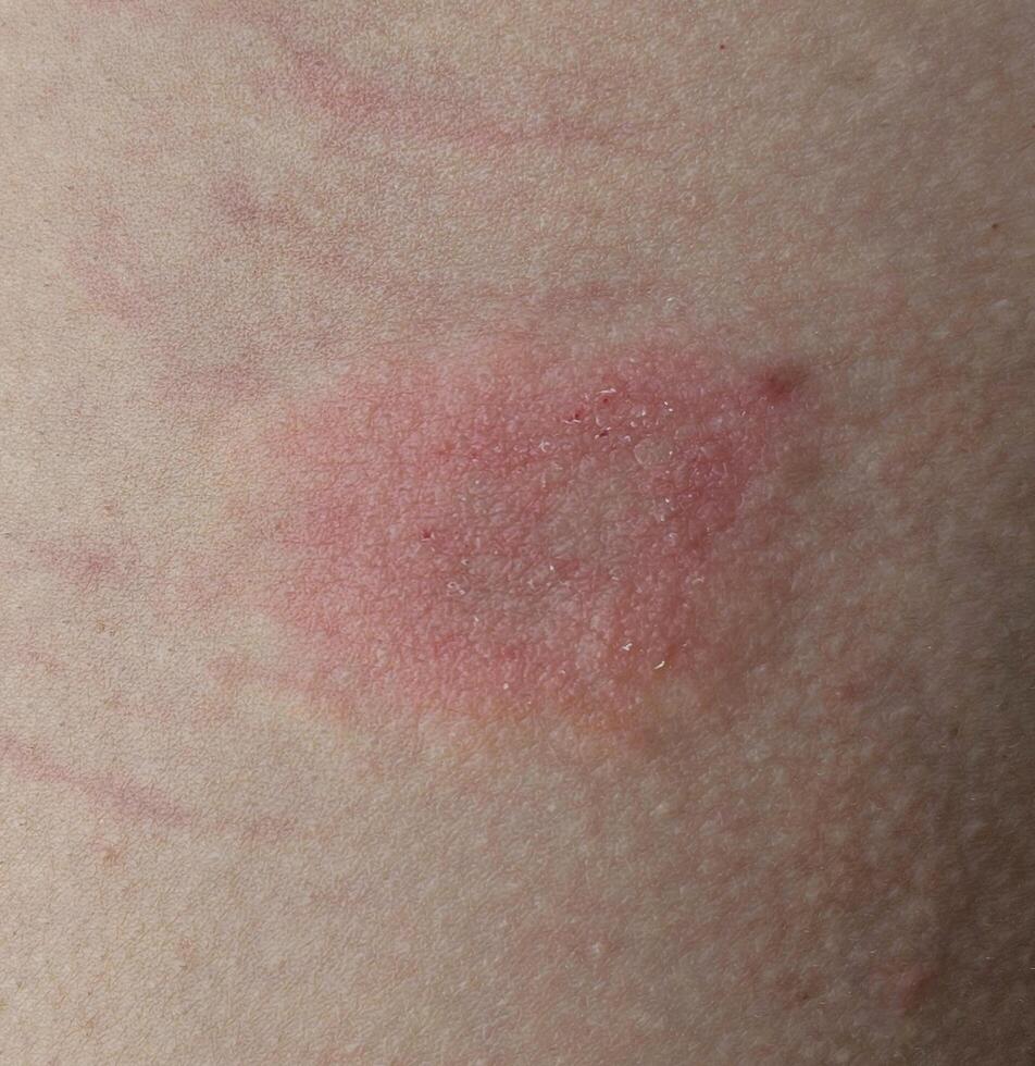 closeup view of skin showing signs of irritation or ringworm, with a reddish-pink rash that appears slightly raised and rough photo