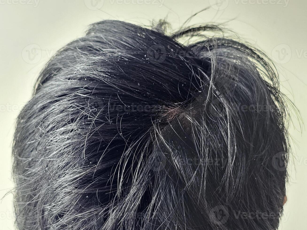 Dandruff on black hair of men photo