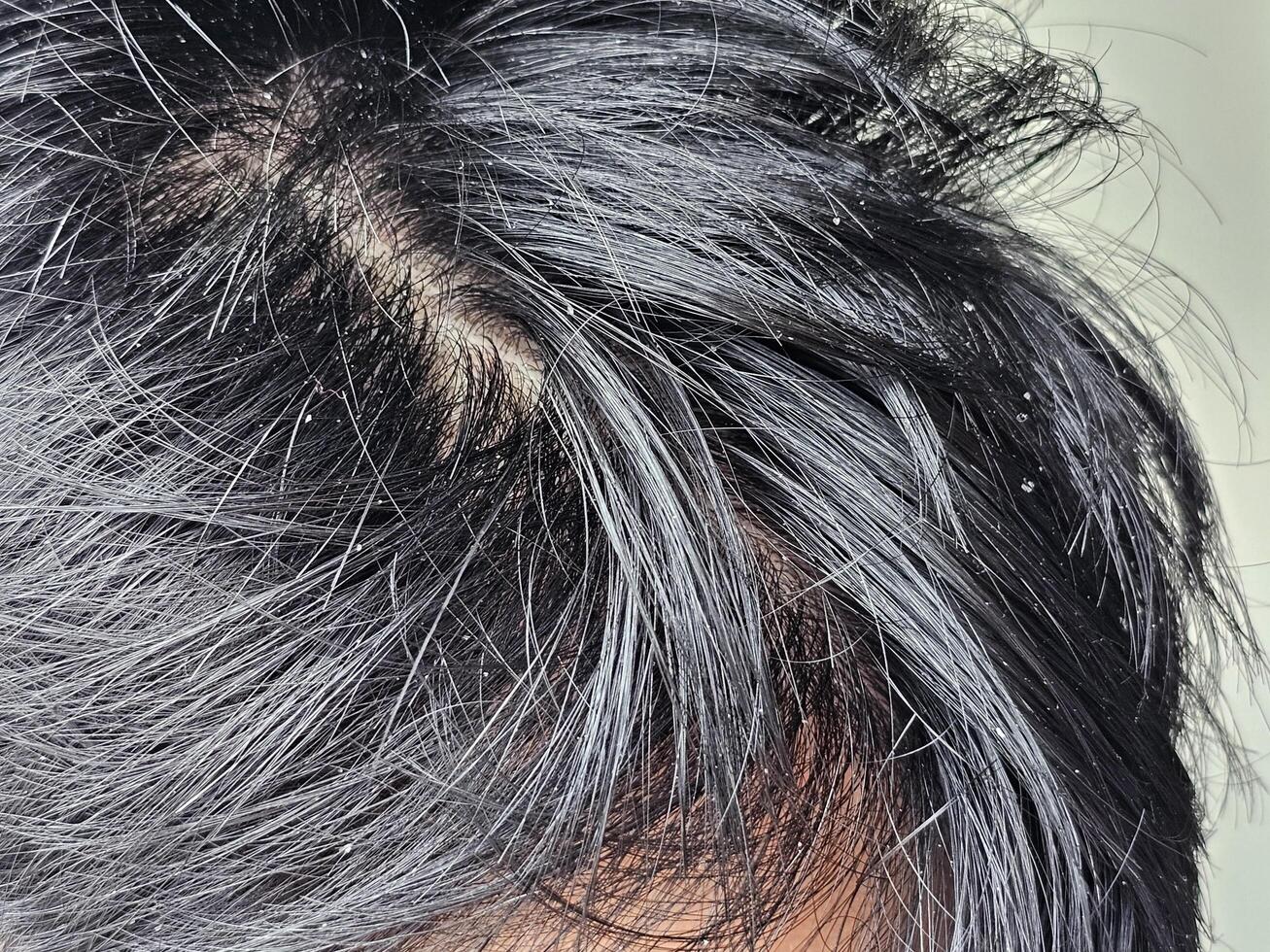 Dandruff visible on the dark hair of an Asian man. photo