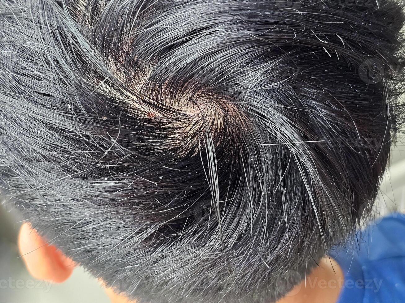Man showing dandruff in dark hair. closeup view photo