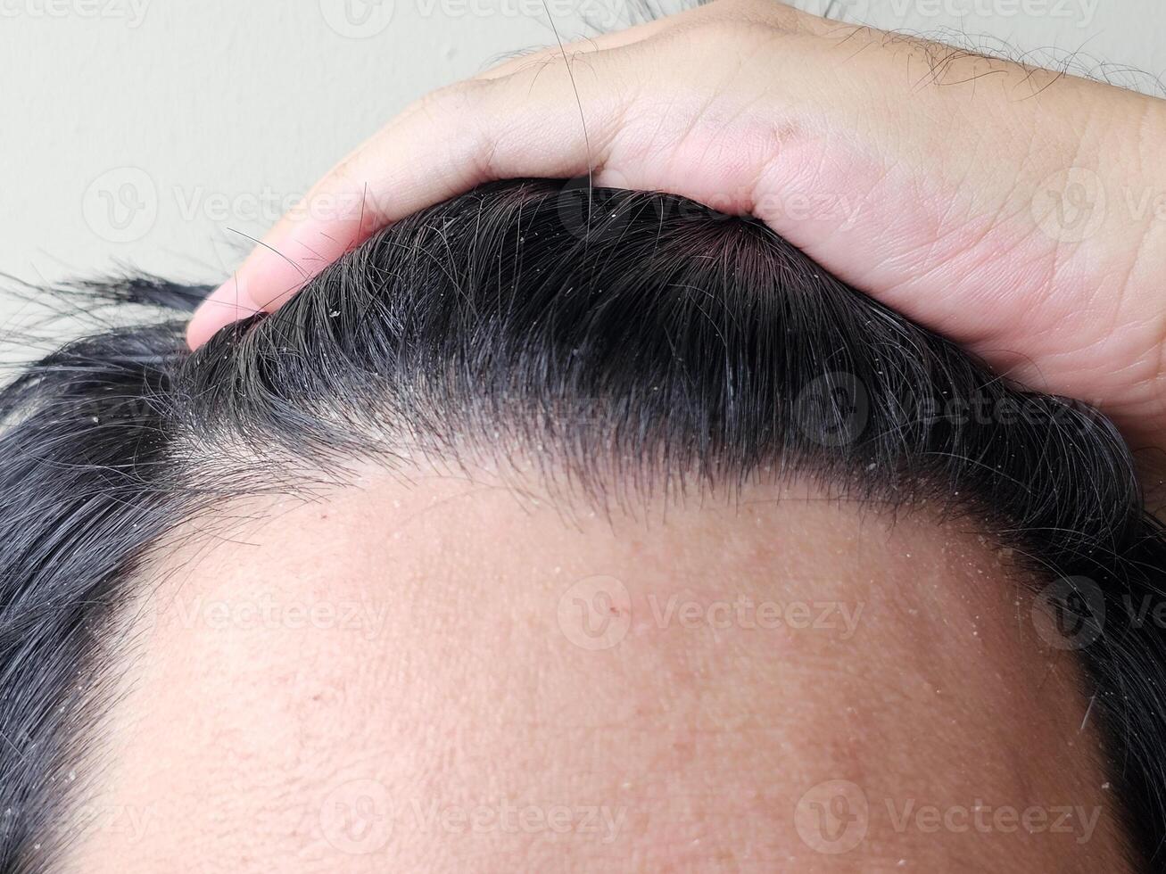 Men with black hair can experience dandruff on their forehead. photo