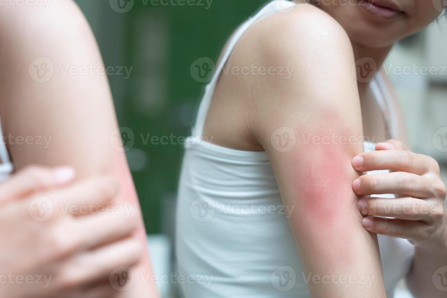 skin problem and beauty. Young woman scratch body has itchy skin from skin allergic, steroid allergy, sensitive skin, red from sunburn, chemical allergy, rash, insect bites, Seborrheic Dermatitis. photo