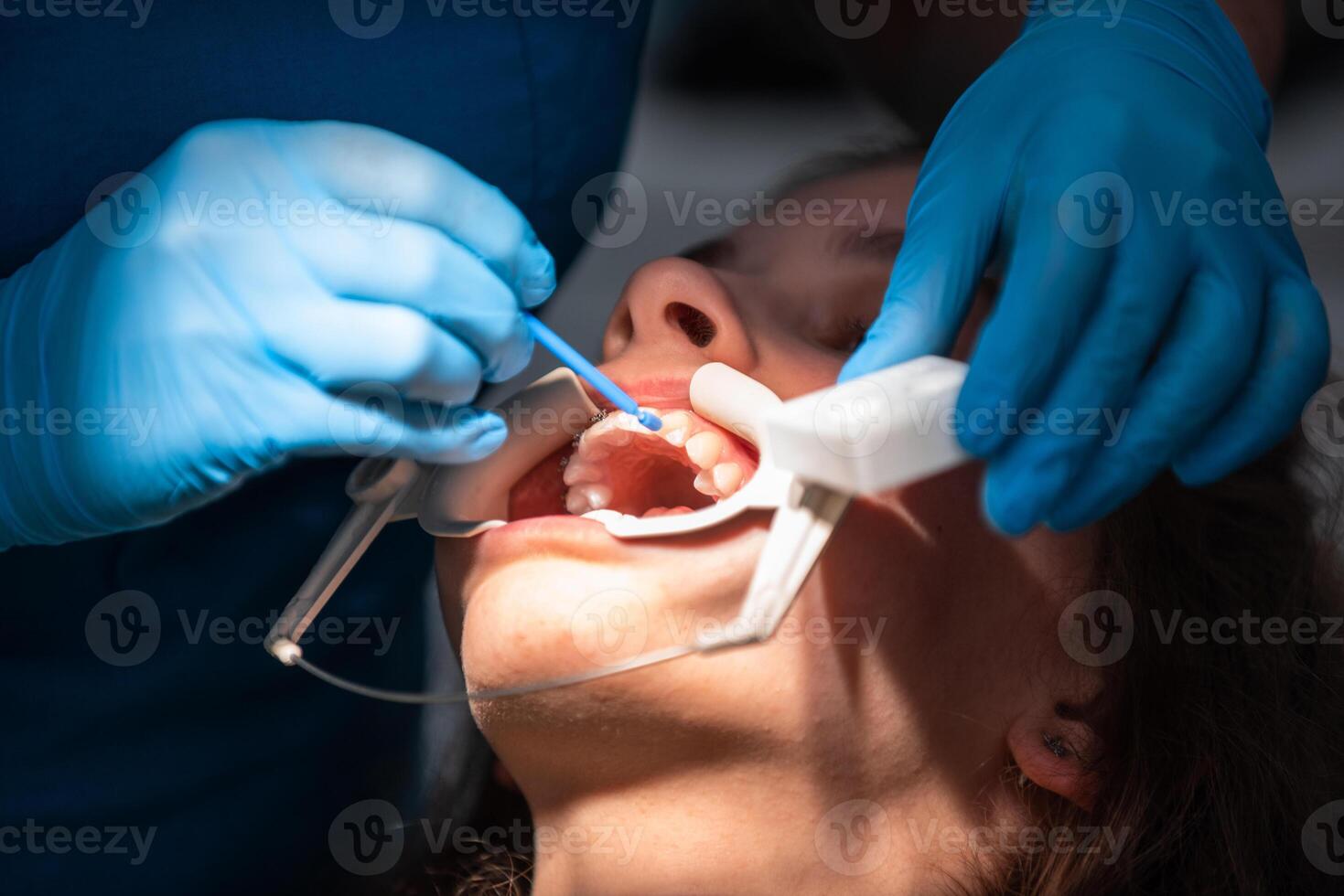 Dentist appointment at a dental clinic, placing braces locks on the teeth and pulling the archwire to fix it photo