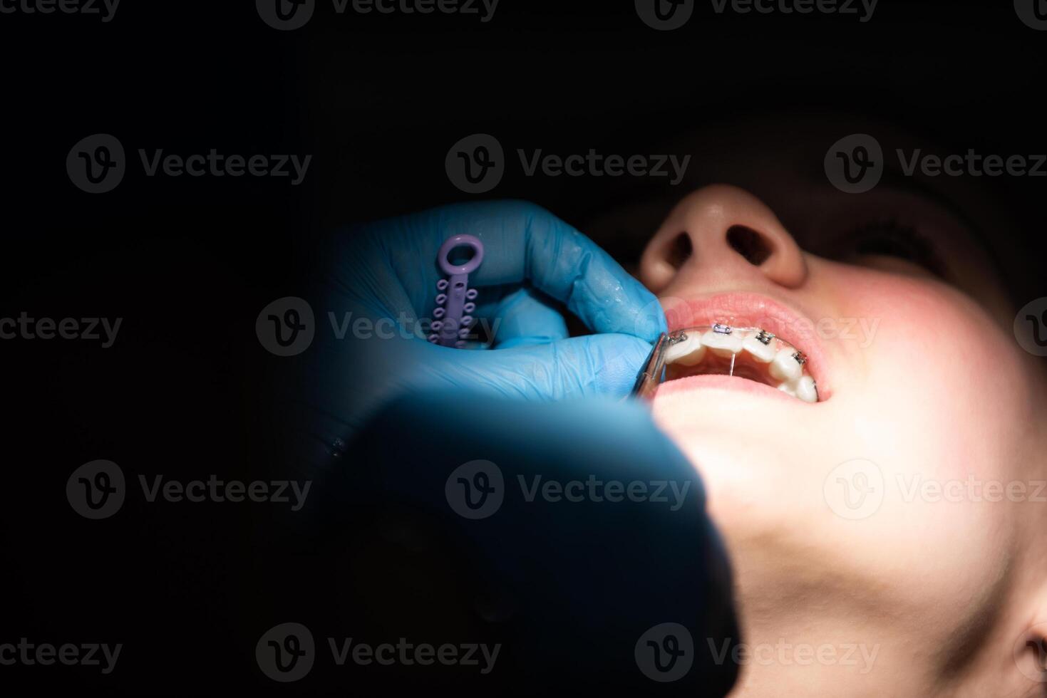 Close up of girl with brackets receiving dental braces treatment in clinic photo