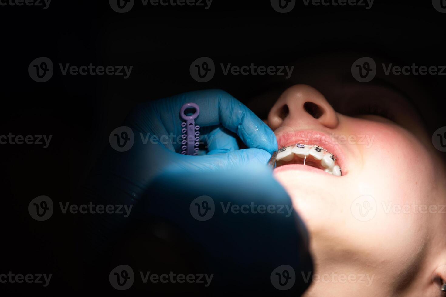 Close up of girl with brackets receiving dental braces treatment in clinic photo