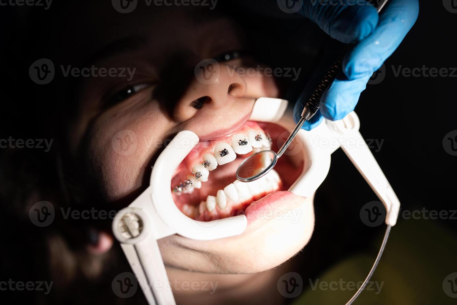 Close up of girl with brackets receiving dental braces treatment in clinic photo