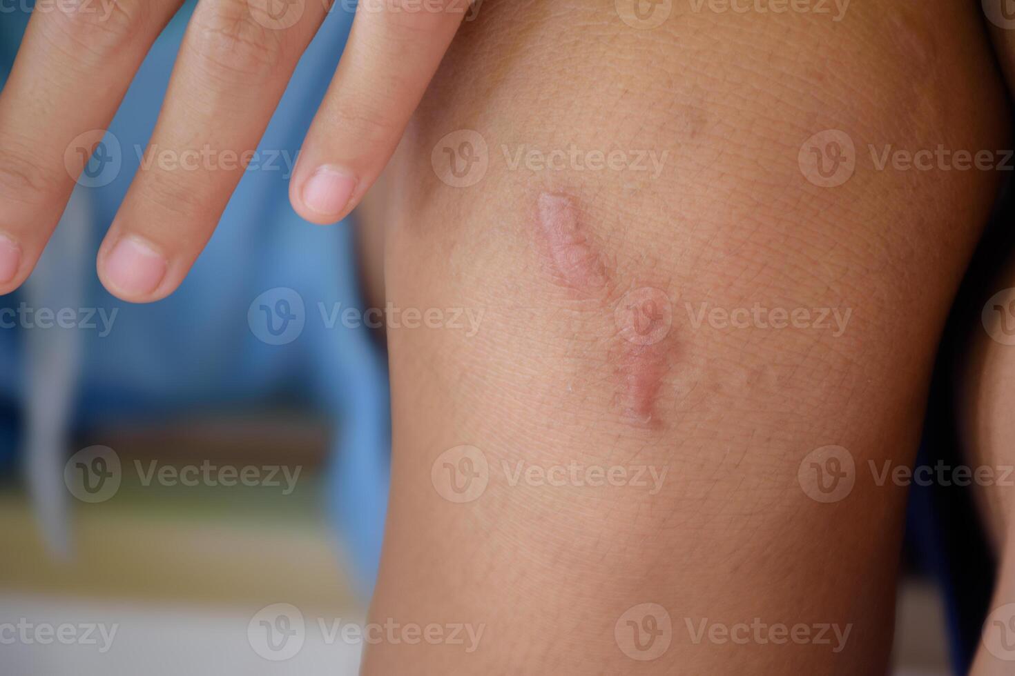 Scar is inflamed and red called keloids on children knee close-up in body parts blurred background concept of skin and wound for medical healthy skin care. photo
