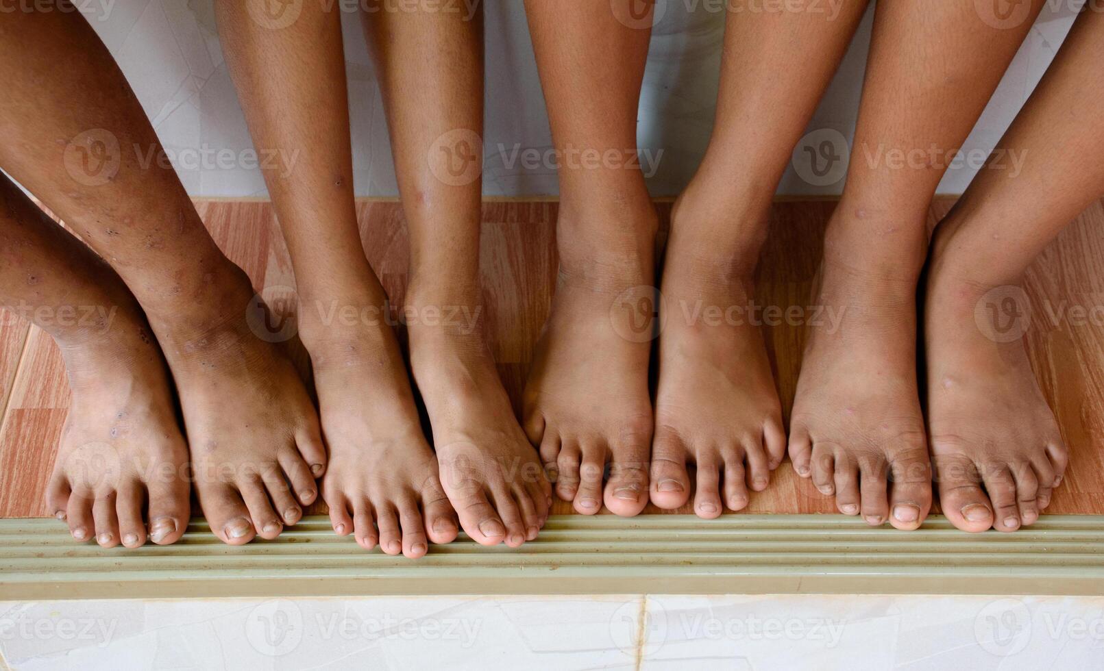 The feet and legs of children with skin diseases or uneven skin from dark spots caused by infections or various skin diseases. photo
