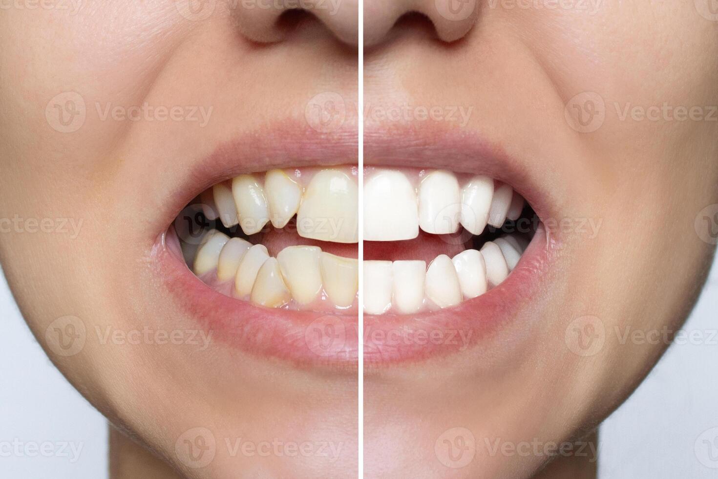 Young woman's smile before and after teeth straightening. Ideal, beautiful shape of teeth on the upper and lower jaw after installing veneers or braces. Bleaching. Dental clinic patient. Whitening photo