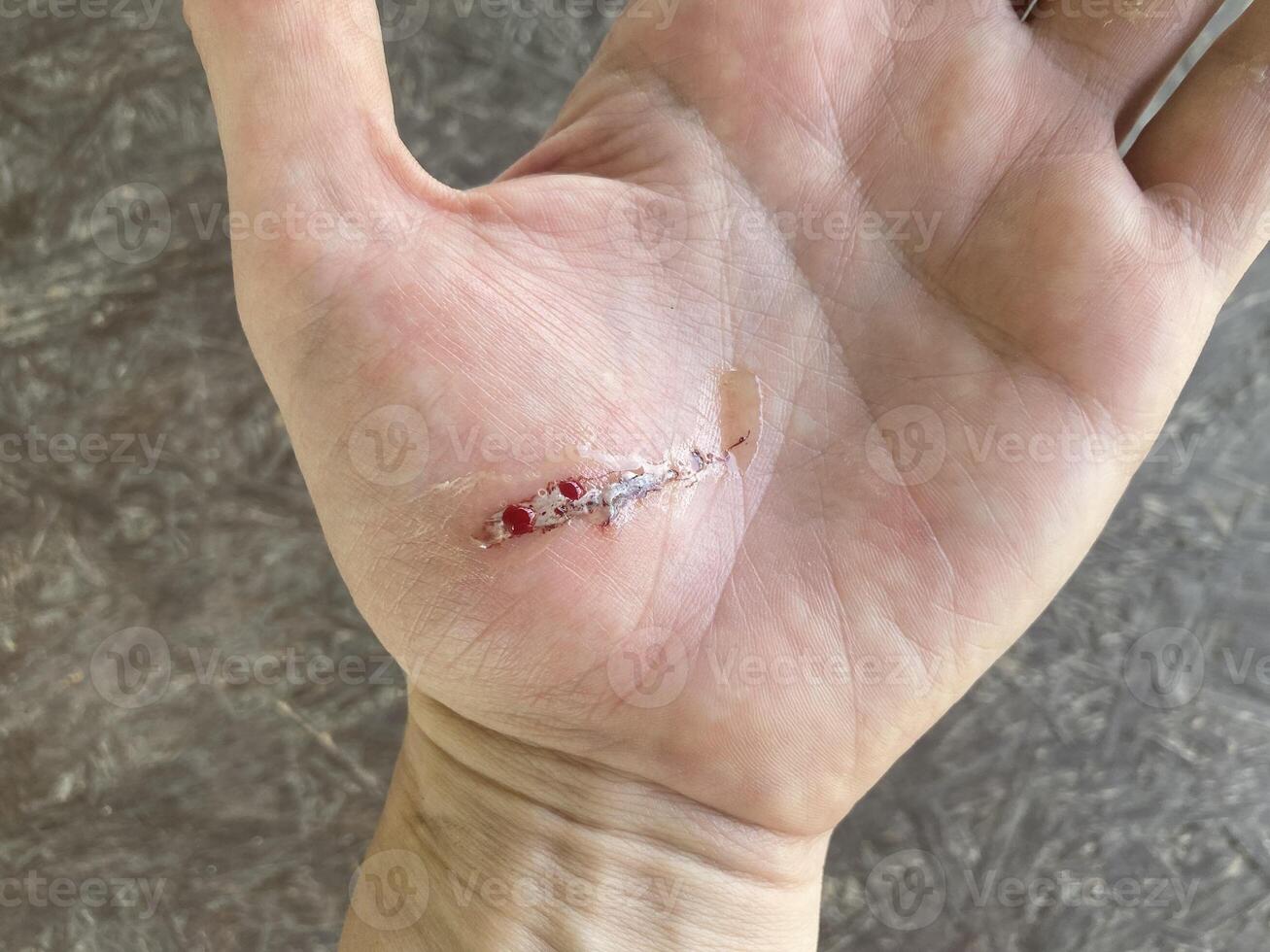 Wound cut on hand from wire photo